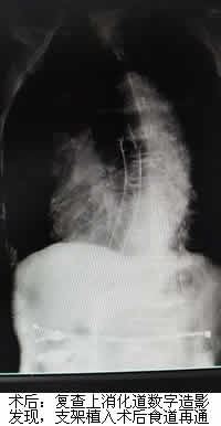 食道支架——解决食管癌患者进食难题