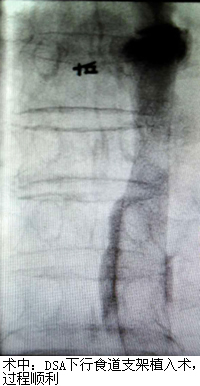 食道支架——解决食管癌患者进食难题
