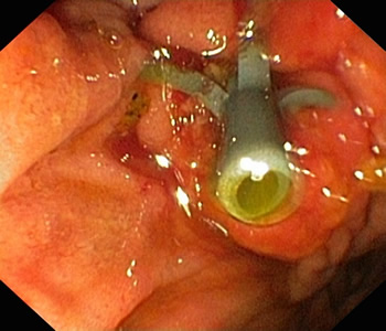 不负台胞信任——我院肝胆胰外科为其成功施行无X线下ERCP术
