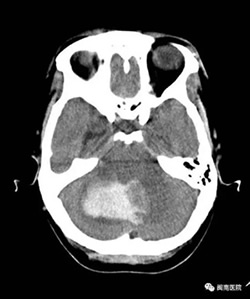 『改善医疗服务行动纪实』--小脑出血危在旦夕之际  “神医”出手解救燃眉之急