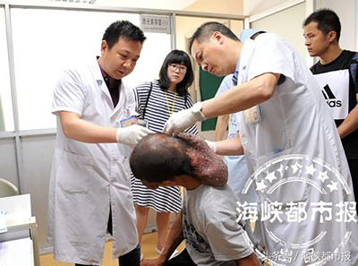 “顶着‘墨鱼脑袋’靠触觉生活22年”追踪--闽清小伙彻底告别“墨鱼头”