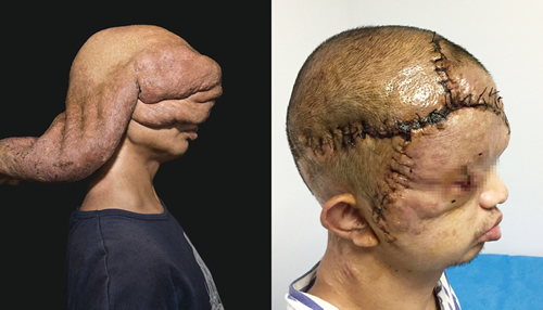 “顶着‘墨鱼脑袋’靠触觉生活22年”追踪--闽清小伙彻底告别“墨鱼头”