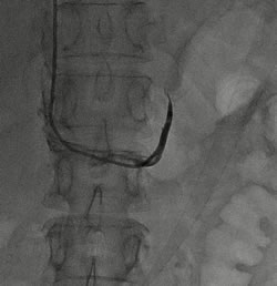 我院成功开展肾上腺静脉采血为实现高血压精准医疗迈出坚实一步