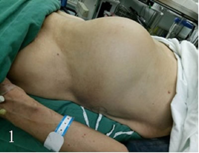 泌尿外科二区成功为一名患者切除巨大肾肿瘤