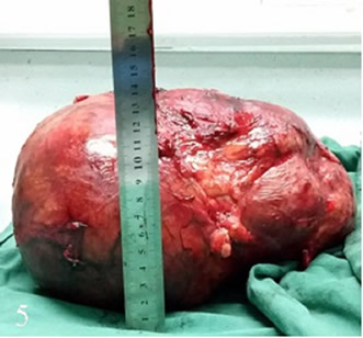 泌尿外科二区成功为一名患者切除巨大肾肿瘤