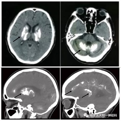 国际神经科学领域顶级期刊“Neuron”发表我院陈万金团队最新研究成果——发现原发性家族性脑钙化症首个隐性遗传致病基因