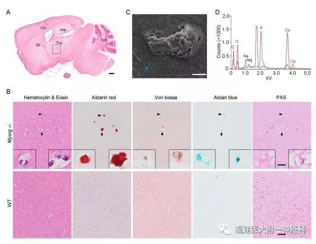 国际神经科学领域顶级期刊“Neuron”发表我院陈万金团队最新研究成果——发现原发性家族性脑钙化症首个隐性遗传致病基因