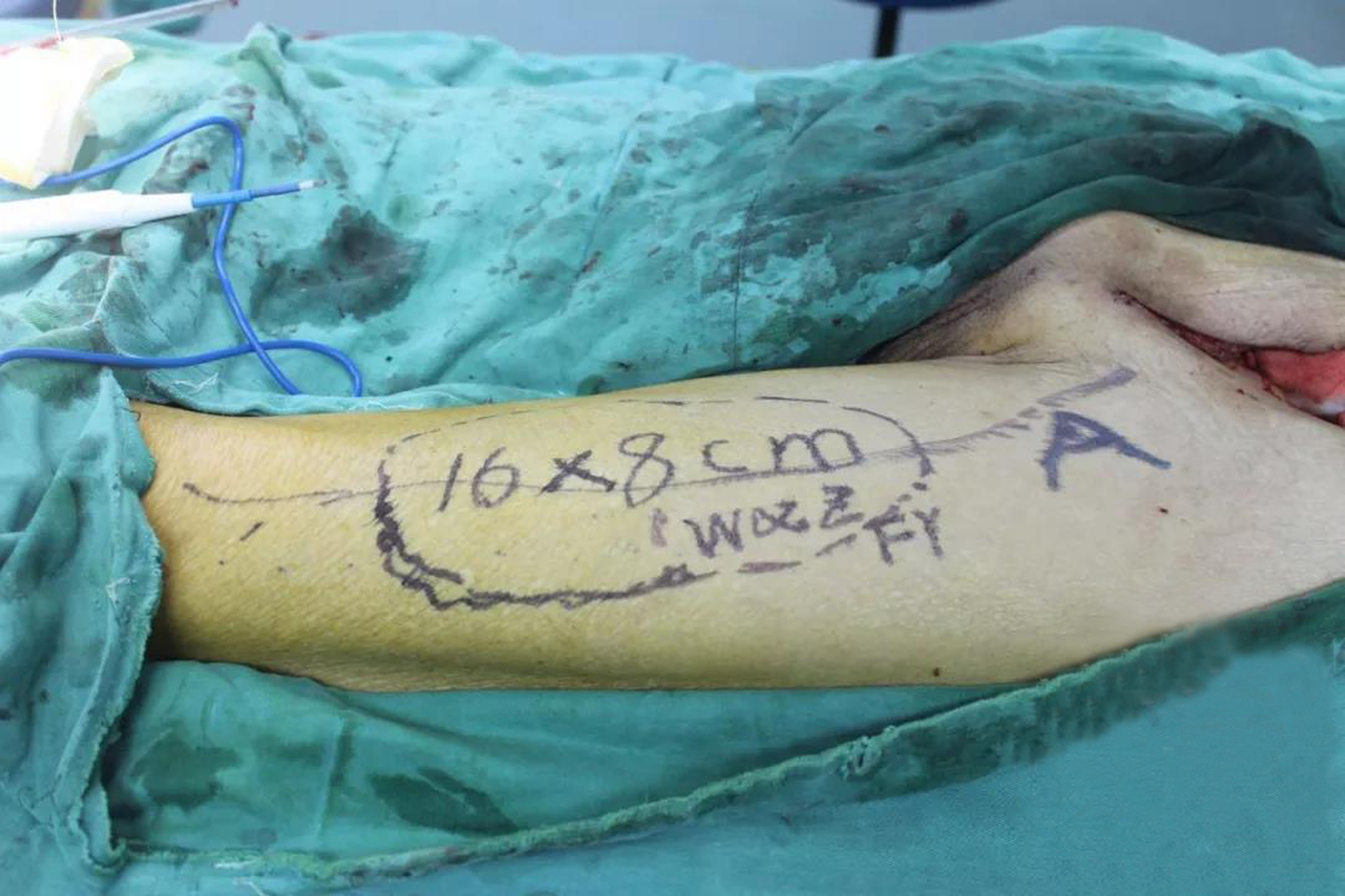 移花接木巧补腹壁巨大缺损——我院肝胆胰外科?疝外科联合多学科成功救治一例巨大腹壁平滑肌肉瘤患者