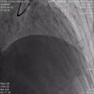 双向转诊显奇效——我院胸痛中心20分钟开通急性心梗患者血管