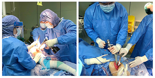 艾滋患者股骨头坏死  关节置换手术被拒我院骨科关爱艾滋患者伸援手  分期双侧关节置换缓病痛