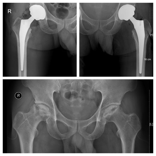 艾滋患者股骨头坏死  关节置换手术被拒我院骨科关爱艾滋患者伸援手  分期双侧关节置换缓病痛