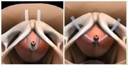 【改善医疗服务行动】我院泌尿外科成功开展无张力尿道悬吊微创手术为压力性尿失禁患者带来福音