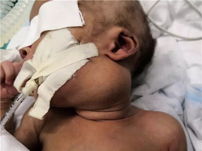 『援非事迹』非洲新生儿患上罕见病，福建援博医生勇“拆弹”