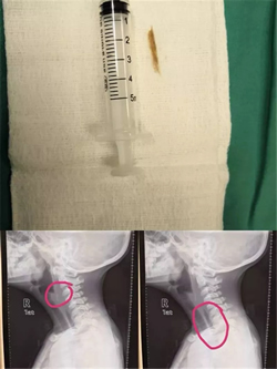 『援非事迹』非洲新生儿患上罕见病，福建援博医生勇“拆弹”