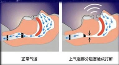 鼾友之约——我院睡眠中心治疗睡眠打鼾情况