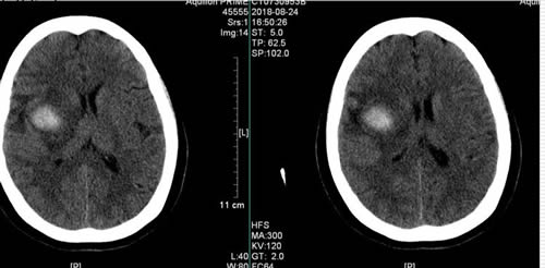 穿越“束”缚　精准“窃”除——我院神经外科应用功能神经导航辅助下Endoport内镜新技术为患者成功切除脑深部海绵状血管瘤