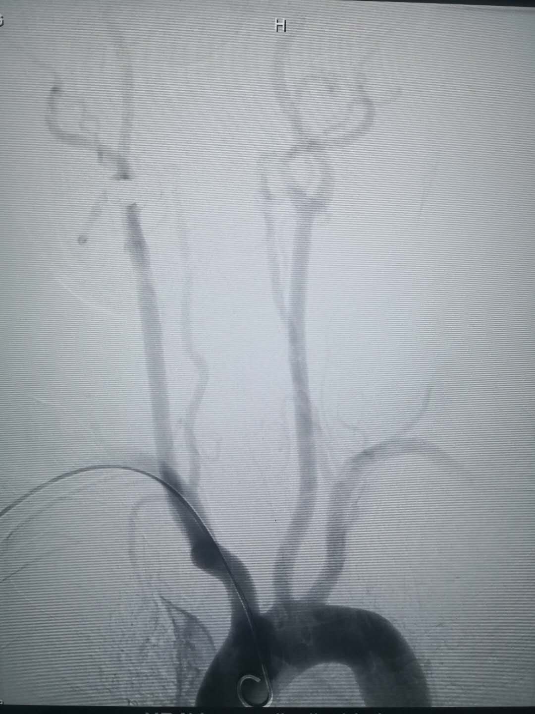 我院成功开展经桡动脉穿刺行全脑血管造影术