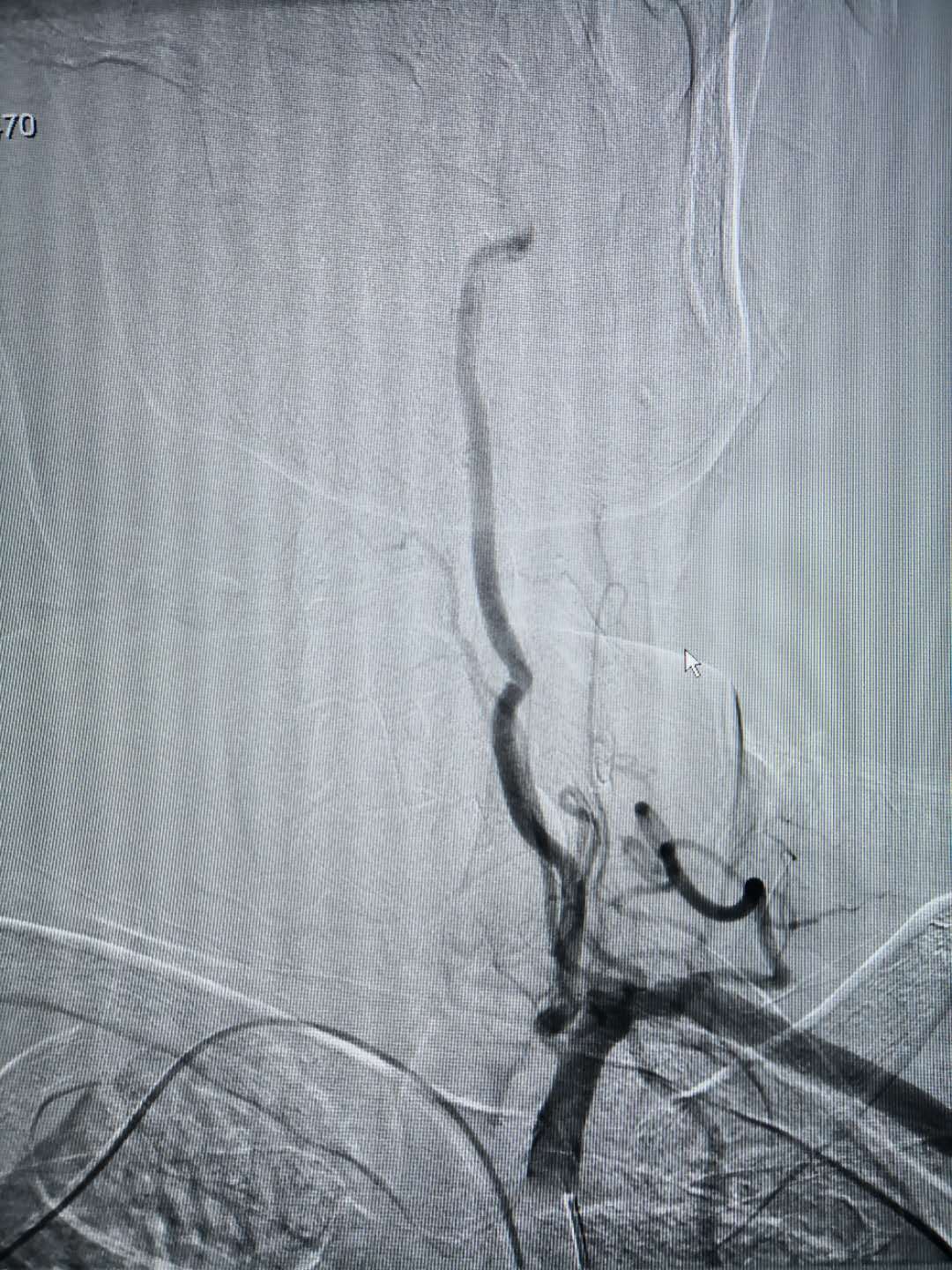 我院成功开展经桡动脉穿刺行全脑血管造影术