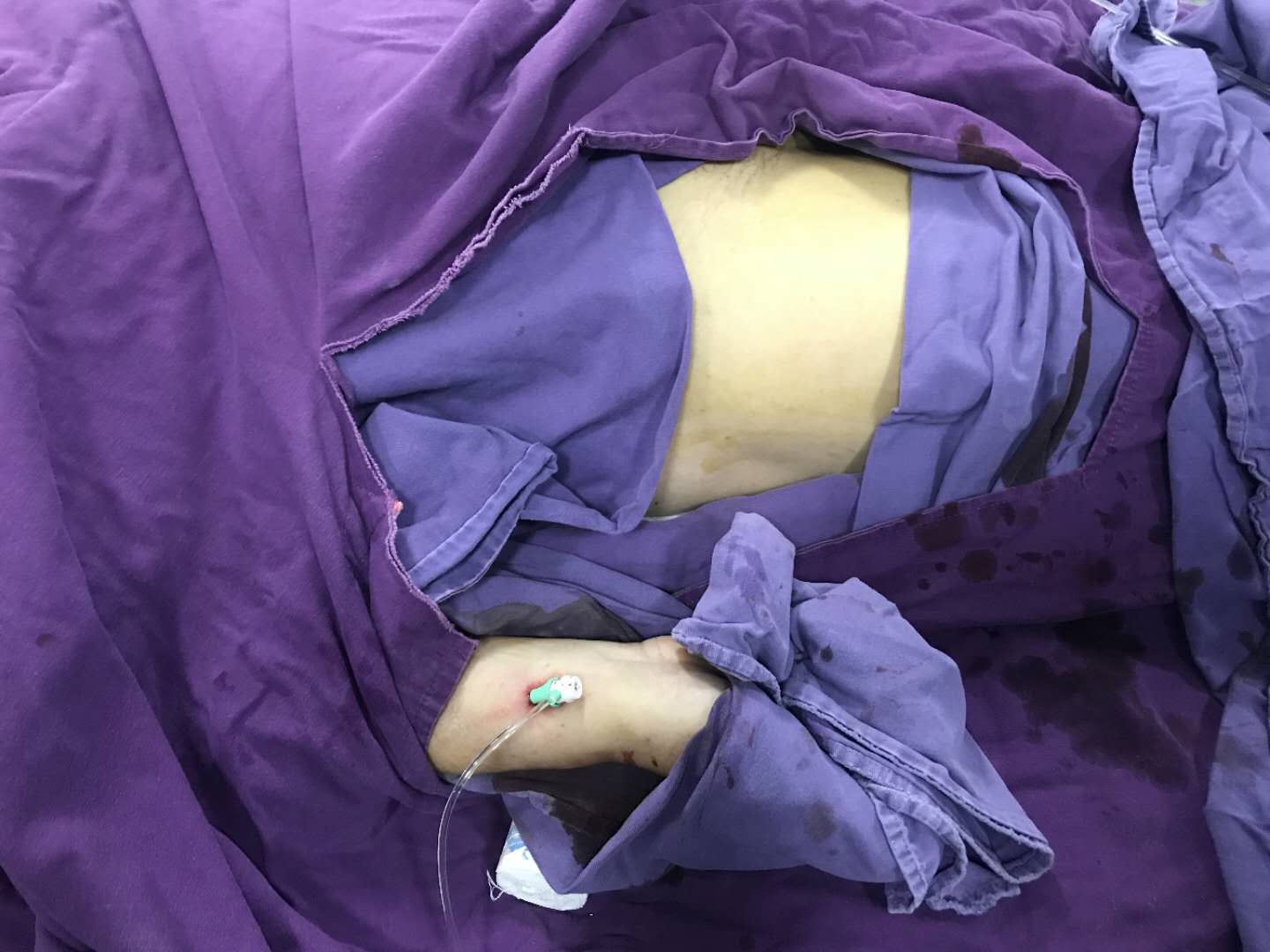 我院成功开展经桡动脉穿刺行全脑血管造影术