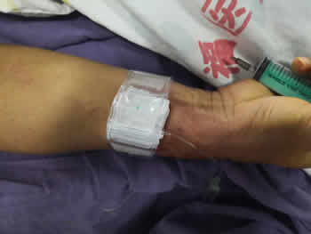 我院成功开展经桡动脉穿刺行全脑血管造影术