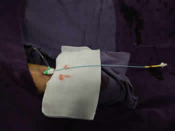 我院成功开展经桡动脉穿刺行全脑血管造影术