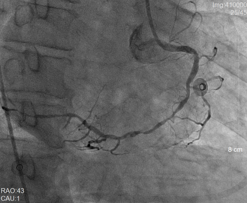 我院多学科联合成功救治一名右位心合并心肌梗死患者