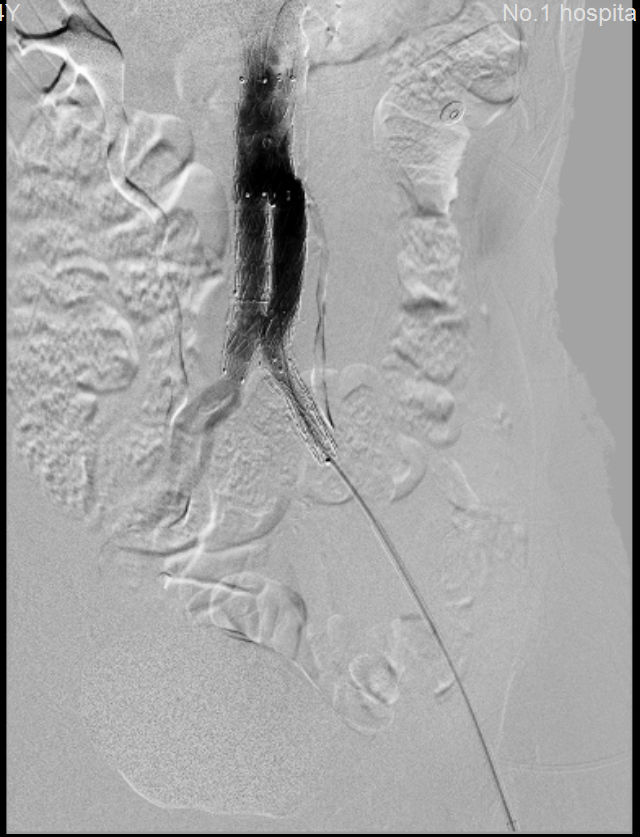 我院多学科协作成功抢救多名主动脉瘤破裂患者