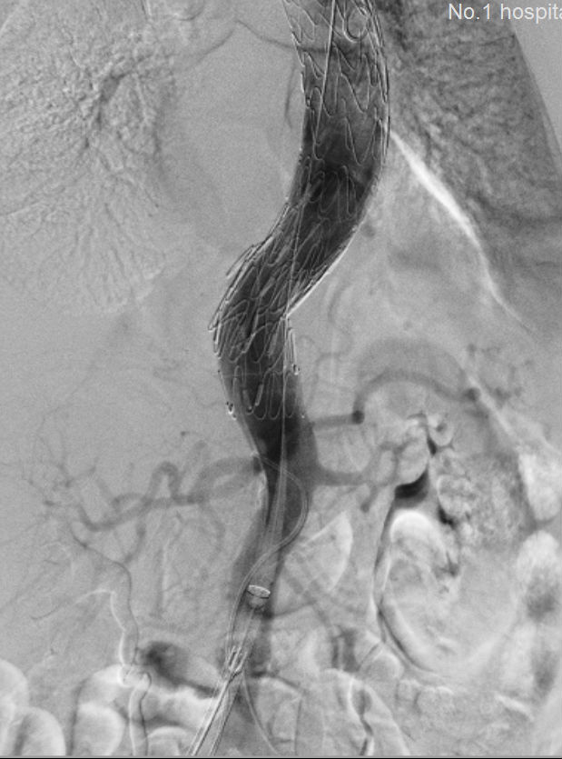 我院多学科协作成功抢救多名主动脉瘤破裂患者