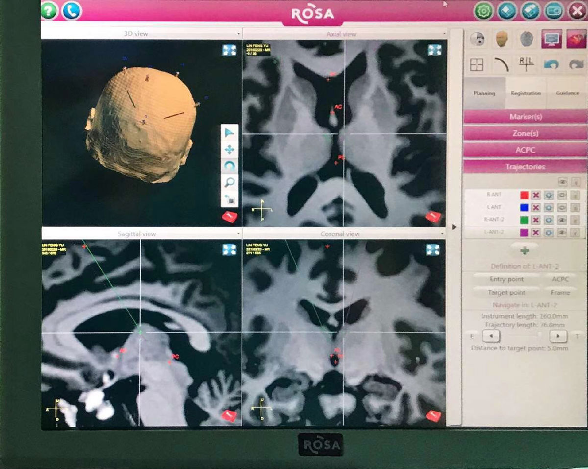 全国首例！我院利用国际新技术ROSA机器人 植入丘脑前核脑起搏器电极治疗癫痫