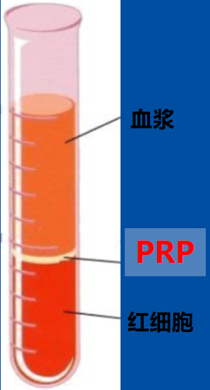 人体自带的神奇修复血浆PRP ——缓解关节疼痛，修复肌腱损伤，加速创面愈合