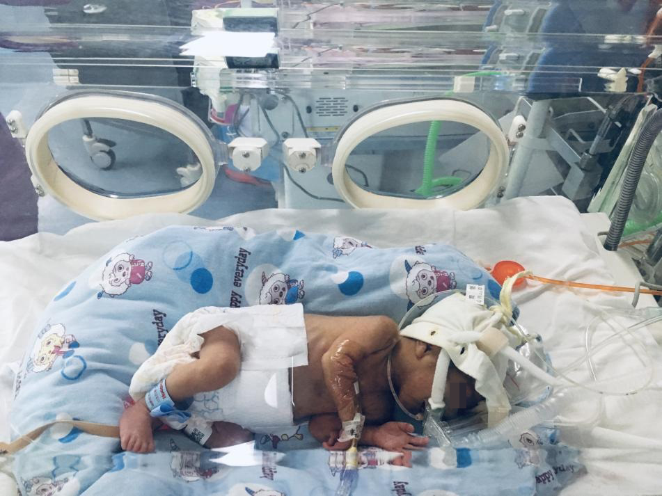 龙凤胎早产生命垂危“筑鸟巢”守护 两个宝宝都只有1公斤多；经过两周多全力抢救，情况好转， 目前体重增至1.8公斤左右