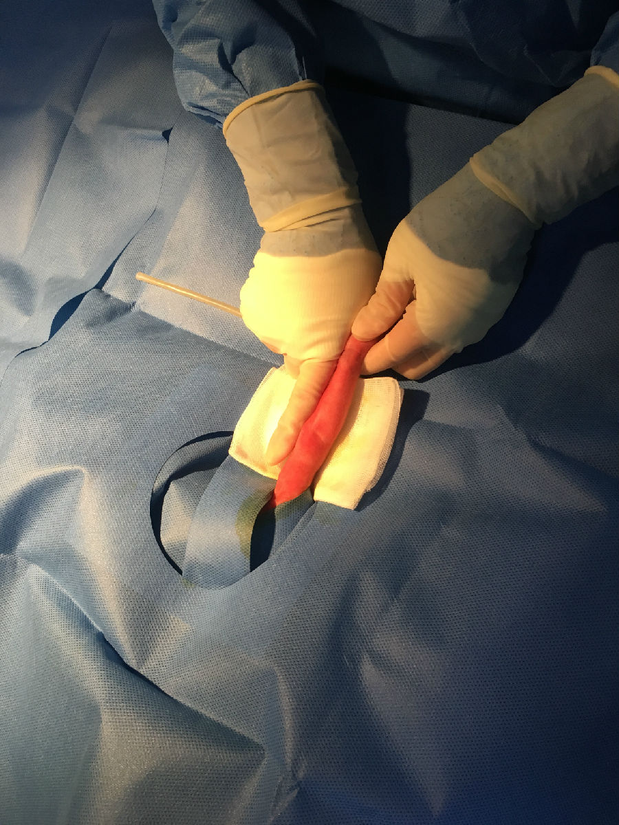 龙凤胎早产生命垂危“筑鸟巢”守护 两个宝宝都只有1公斤多；经过两周多全力抢救，情况好转， 目前体重增至1.8公斤左右