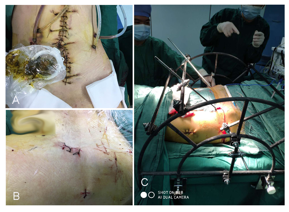 Starr架复位系统“暗箱操纵”巧治骨盆骨折