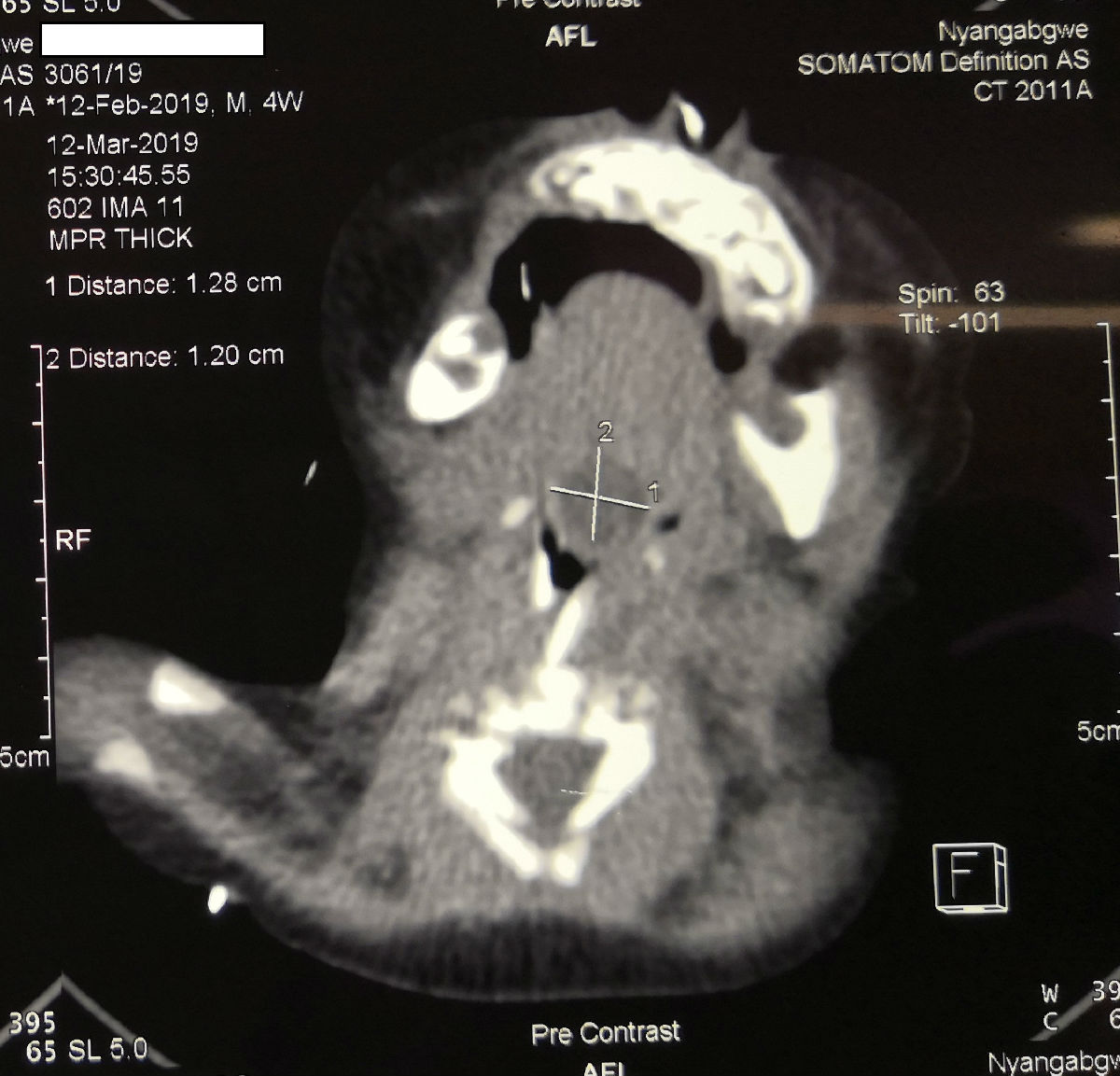 中央电视台《华人世界》报道我院援博队员陈希杭先进事迹 ——自制手术器械帮助当地婴儿切除舌根囊肿