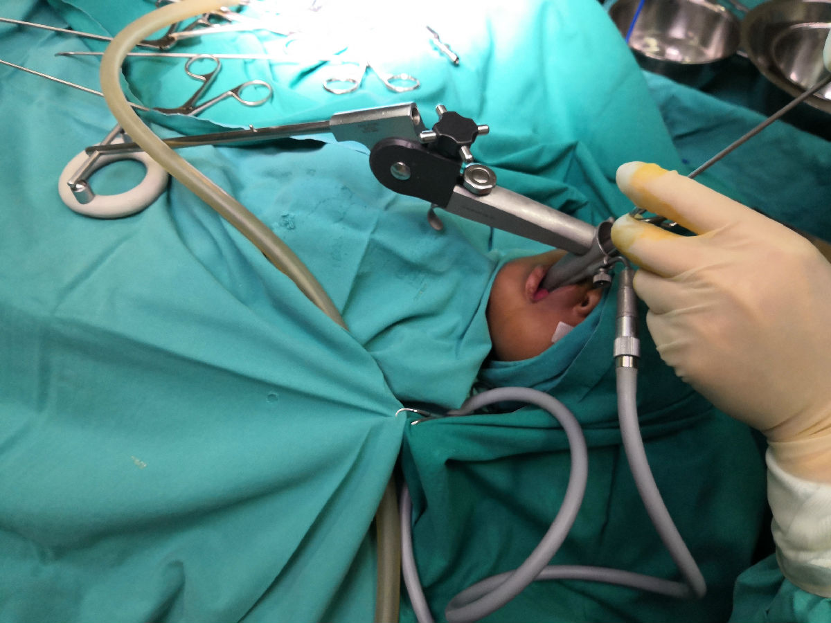 中央电视台《华人世界》报道我院援博队员陈希杭先进事迹 ——自制手术器械帮助当地婴儿切除舌根囊肿