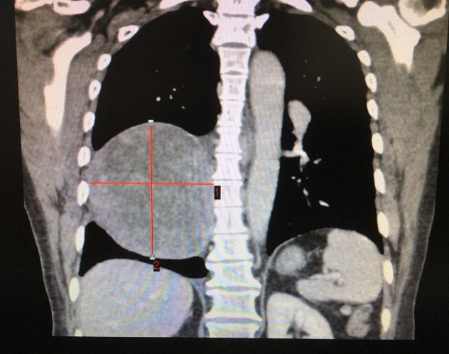 胸外科“拆弹”专家再拆除重磅“炸弹”