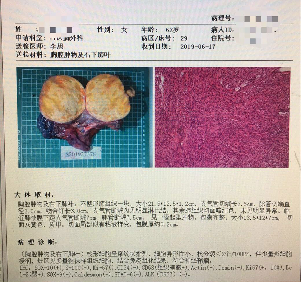 胸外科“拆弹”专家再拆除重磅“炸弹”