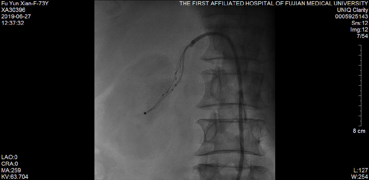 我院心内科又成功救治一例尿毒症难治性高血压合并冠状动脉严重病变患者