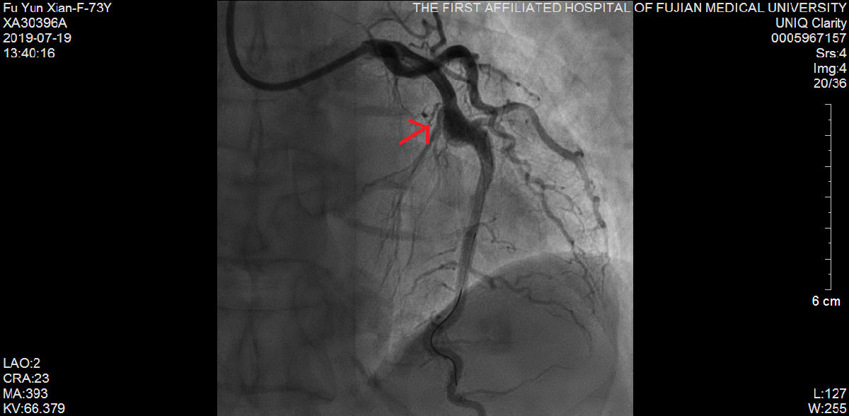 我院心内科又成功救治一例尿毒症难治性高血压合并冠状动脉严重病变患者