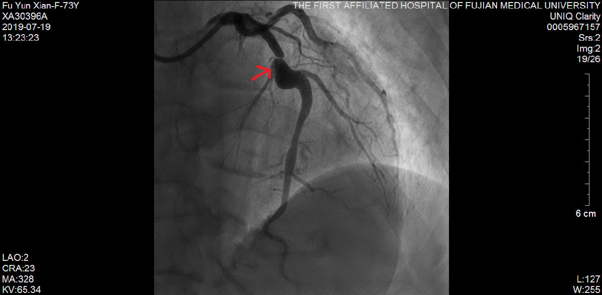 我院心内科又成功救治一例尿毒症难治性高血压合并冠状动脉严重病变患者