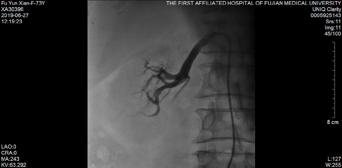 我院心内科又成功救治一例尿毒症难治性高血压合并冠状动脉严重病变患者