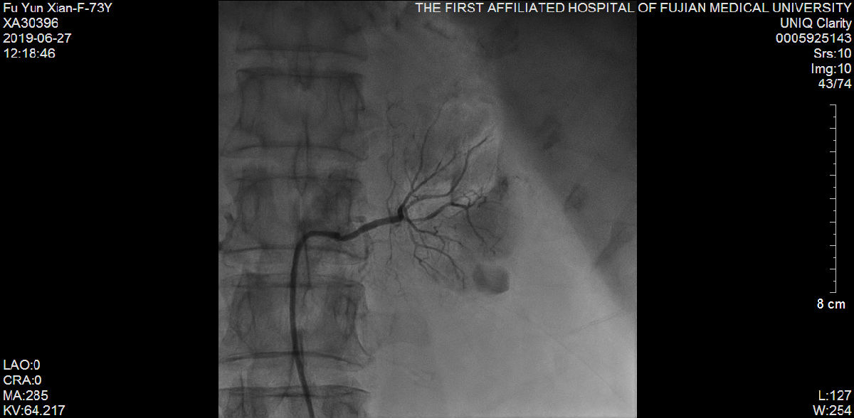 我院心内科又成功救治一例尿毒症难治性高血压合并冠状动脉严重病变患者