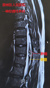 我院援宁队员郑小斌联手当地医院神经脊柱外科完成高难度脊髓髓内血管性肿瘤切除手术