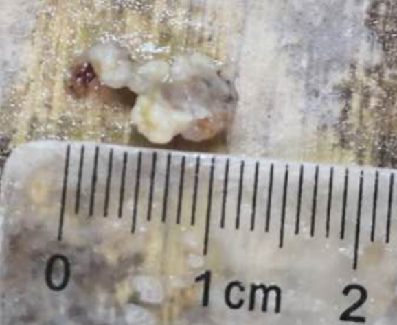 我院援宁队员郑小斌联手当地医院神经脊柱外科完成高难度脊髓髓内血管性肿瘤切除手术