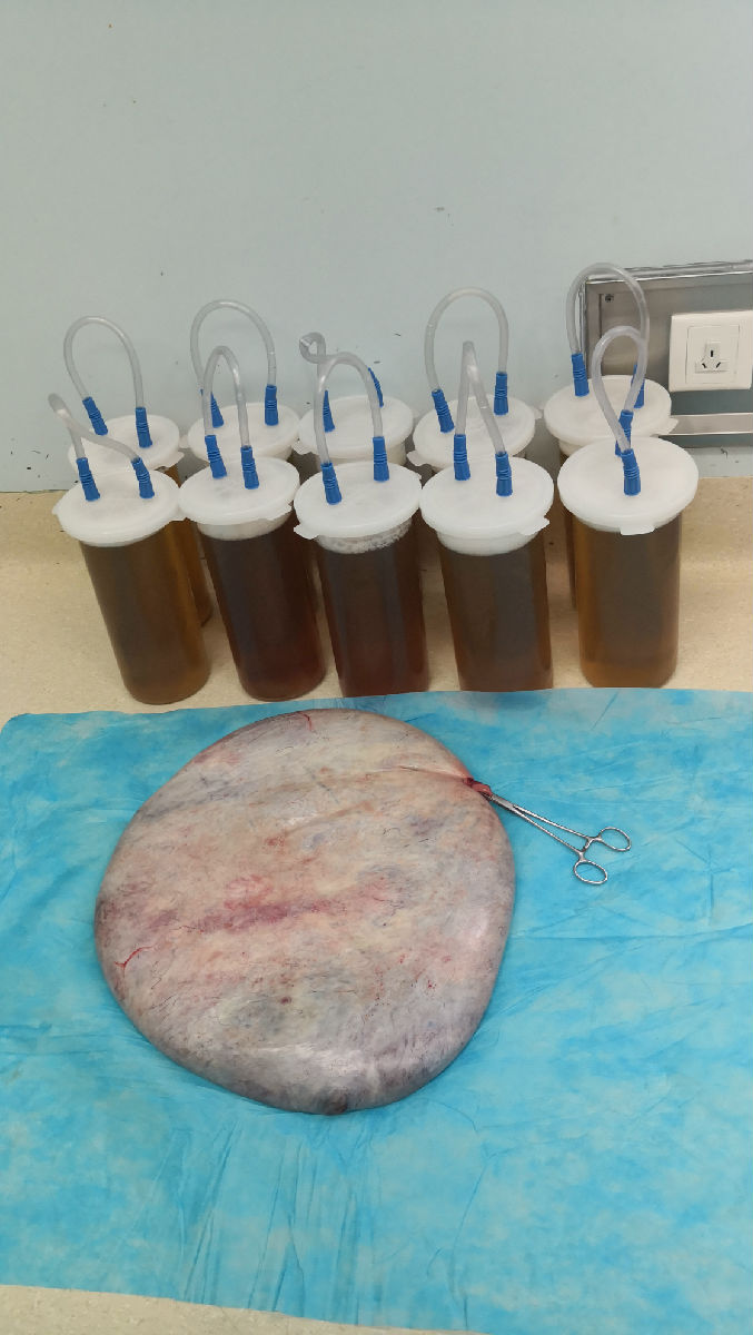 我院援宁医疗队合力救治神经管畸形合并巨大腹腔肿瘤患者