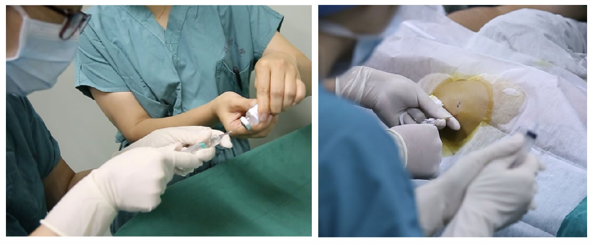 全国五城市同步开启反义寡核苷酸技术治疗脊髓性肌萎缩症福建省首个受益患者在福建医大附一医院完成鞘内注射