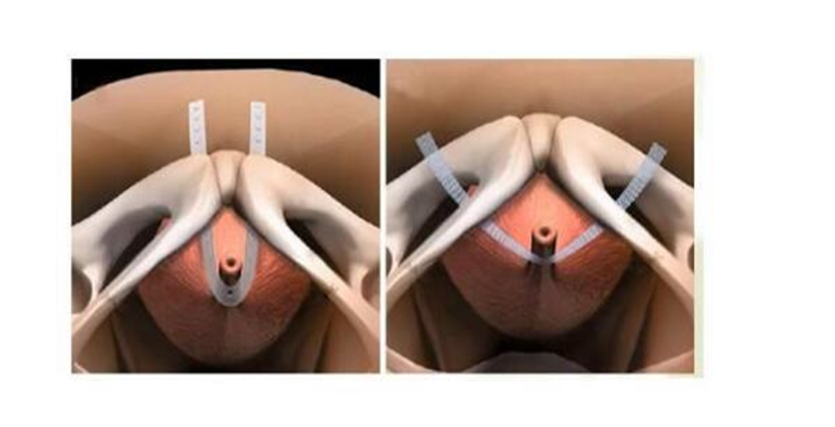 上午入院手术，下午回家！ 我院泌尿外科压力性尿失禁可做“日间手术”了