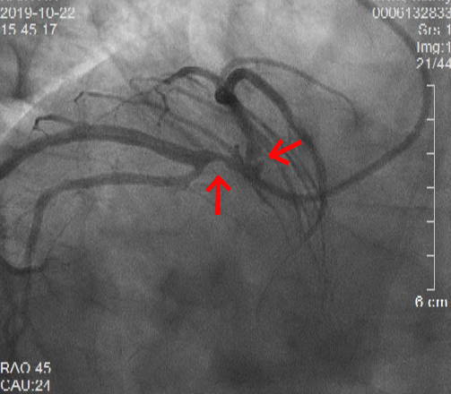 92岁罕见“镜面人”心肌梗死 我院心内科团队成功为其完成左主干分叉病变双支架治疗