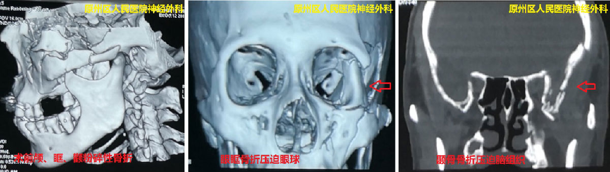 男子面部骨折压迫脑和眼 我院援宁队员协助当地医院神经外科实施“额颞眶颧入路”手术力挽狂澜