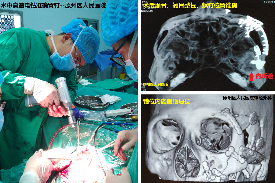 男子面部骨折压迫脑和眼 我院援宁队员协助当地医院神经外科实施“额颞眶颧入路”手术力挽狂澜